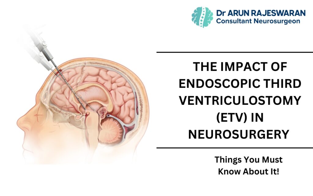 The Impact of ETV in Neurosurgery: ETV in Hydrocephalus Treatment