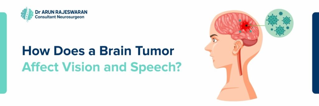 How Does a Brain Tumor Affect Vision and Speech?