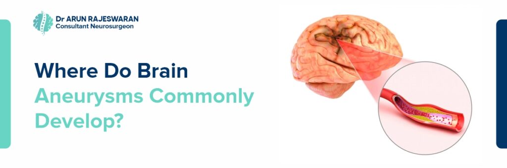 Where Do Brain Aneurysms Commonly Develop?
