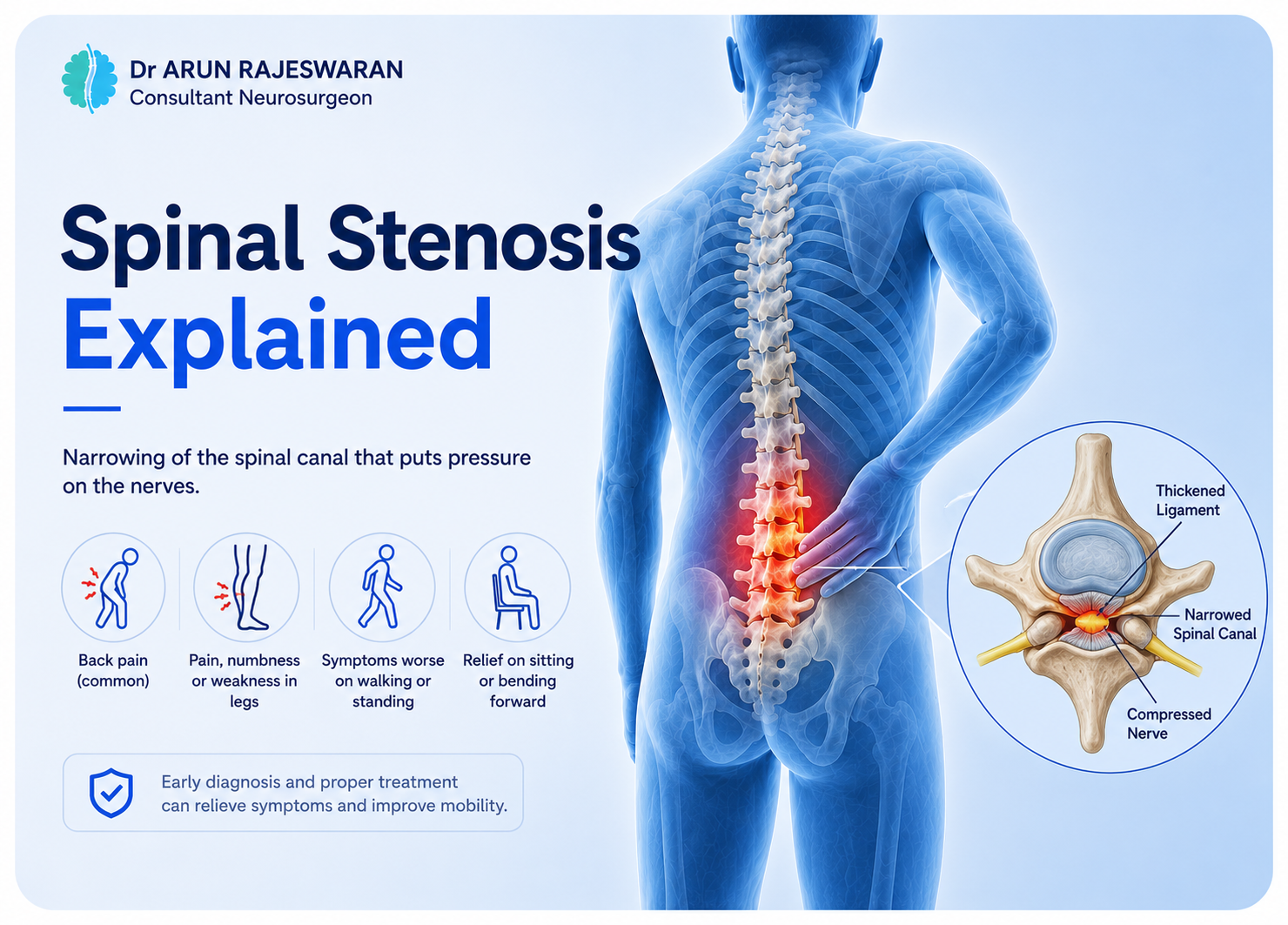 Spinal Stenosis Explained: Why the Spinal Canal Narrows and What Can Be Done About It
